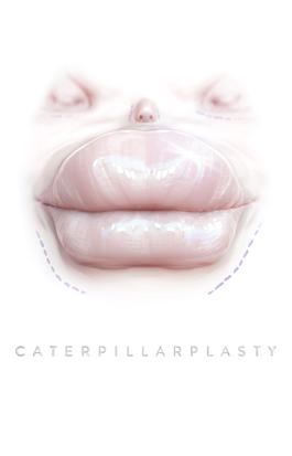 Caterpillarplasty