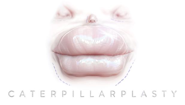Caterpillarplasty