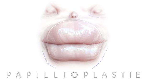 Papillioplastie